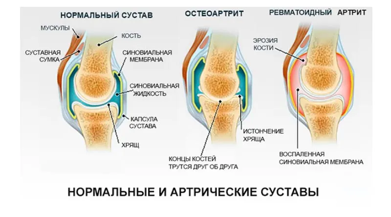 артрит